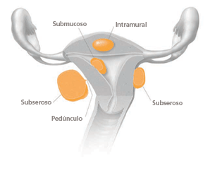 Diagrama de fibromas en el útero
